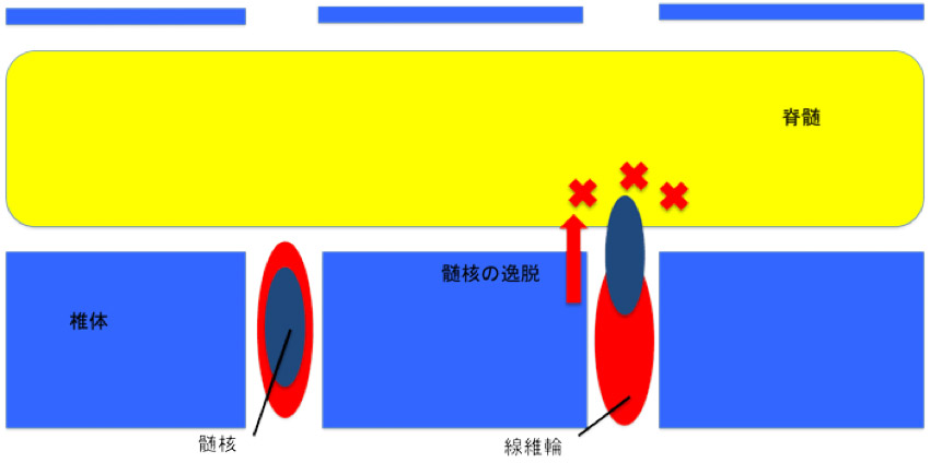 椎間板ヘルニア図
