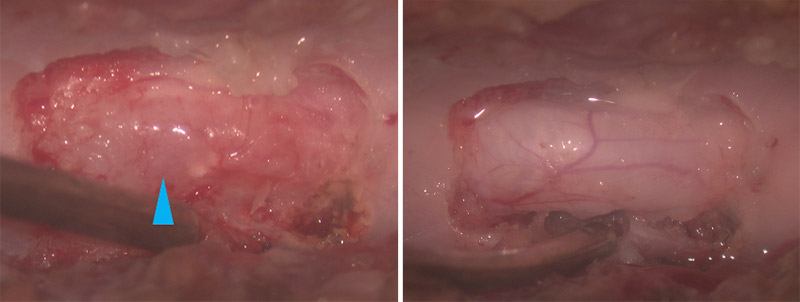 胸腰部椎間板ヘルニアに対する片側椎弓切除術