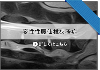 変性性腰仙椎狭窄症